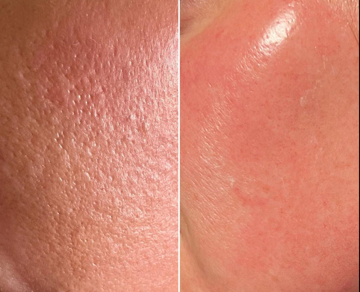 BioRePeel (chemical peel)