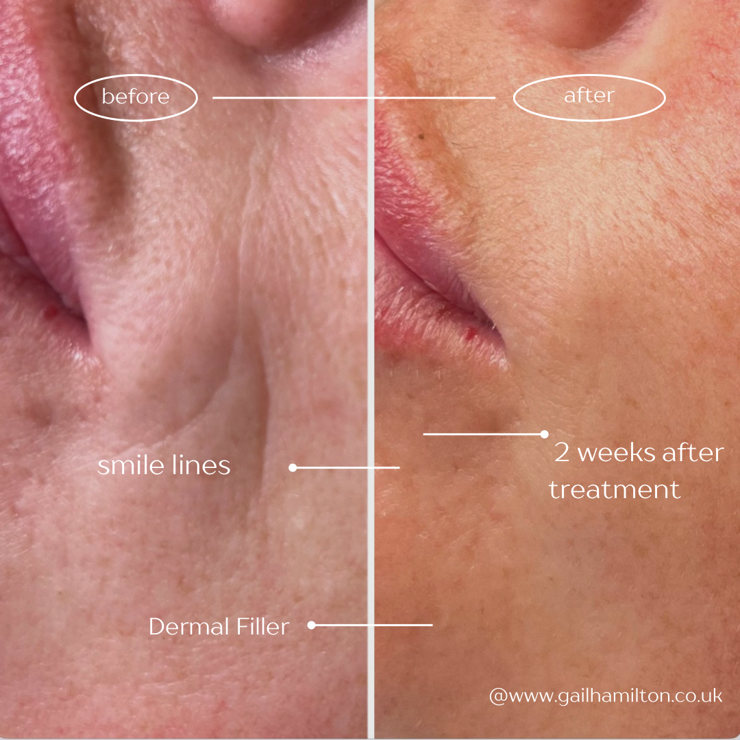 Nasolabial Folds