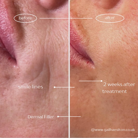 Nasolabial Folds